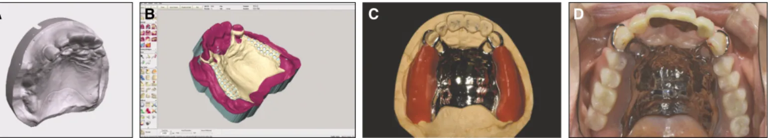 Fig. 5. Summarized photographs of case 2. A: the solid computer model of the patient’ s cast, B: electronic surveying and framework design on FreeForm software, C: com- com-pleted framework on master cast, D: final prosthesis put on patient’ s upper arch.