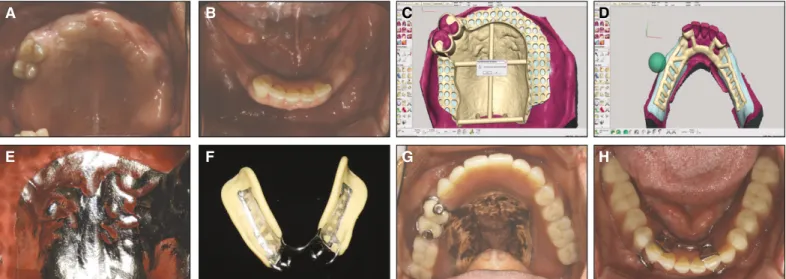 Fig. 7. Summarized photographs of case 4. A: occlusal view after natural teeth alteration, B: completed framework design, C: tissue surface of framework and characteristic contour line on palate area, D: final prosthesis put on patient’ s upper arch.