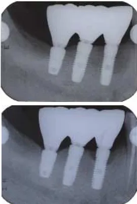 Fig. 2. Marginal bone loss around the fractured abutment screw. From first frac- frac-ture, the other fractures were consequently happened (Fig