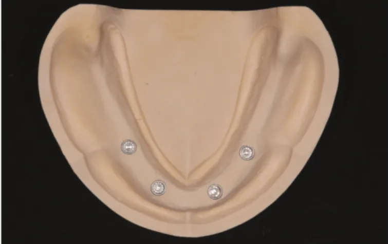 Fig. 1. Metal framework simulating a prosthesis that directly connected to four inter- inter-nal-connection implants.
