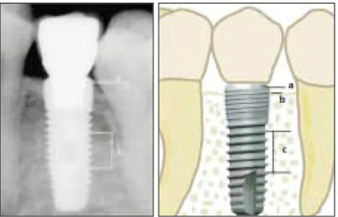 Fig. 2. References used to measure actual marginal bone loss.