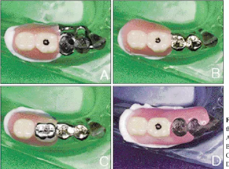 Fig. 4. Unilateral free-end removable partial dentures on the photoelastic model. 
