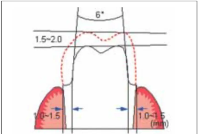Table I. Group naming of zirconia coping by design