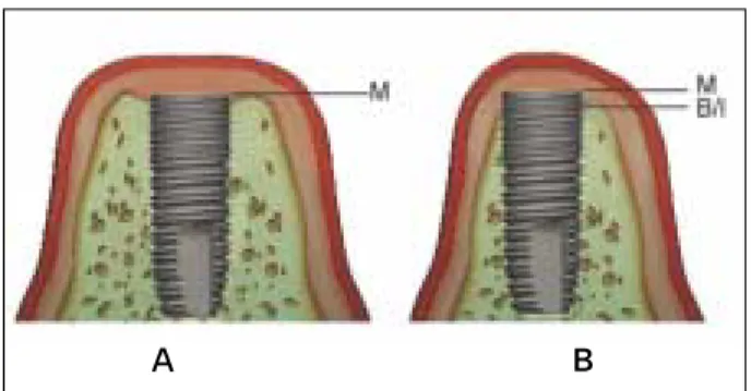 Fig. 2. Schematic drawing describing bone contact (A) and bone area (B).
