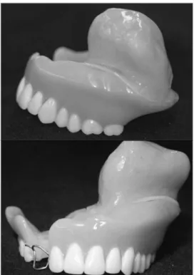 Fig. 4. The extraoral lateral and front view of com- com-piled prosthesis.
