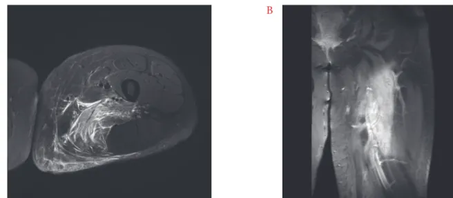 Fig. 1. Magnetic resonance imaging of left thigh. (A) Axial T2-weighted image with fat suppression, demonstrating  enlargement and diffusely increased signal intensity of the adductor magnus muscle and irregular hypointense area  at the center