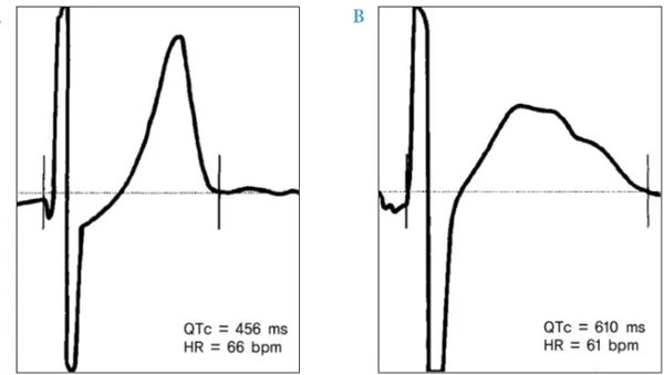 Fig. 2. An electrocardiogram from a subject at hypoglycemic state (B) shows prolonged QT interval and prominent  T and U waves, compared with an electrocardiogram from a subject at euglycemia (A)