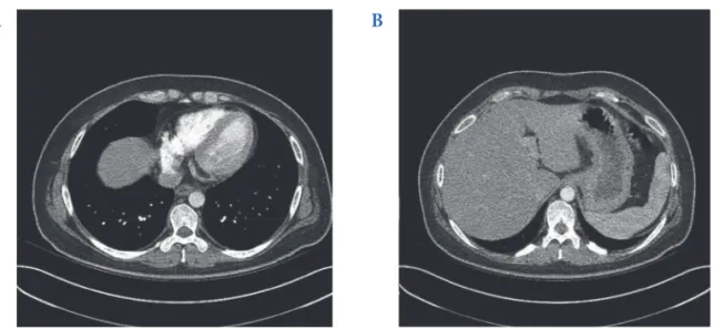 Fig. 4. Neck computed tomography shows eccentric  intramural abscess with wall thickening of cervical  esophagus.