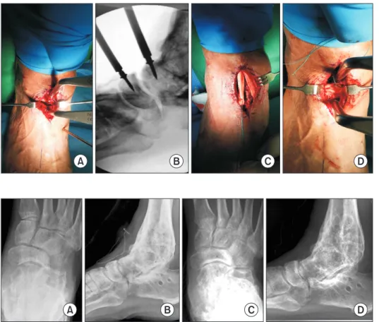 Figure 3. (A, B) Talonavicular joint space was  distracted by use of pin distractor, which was  verified by fluoroscopy