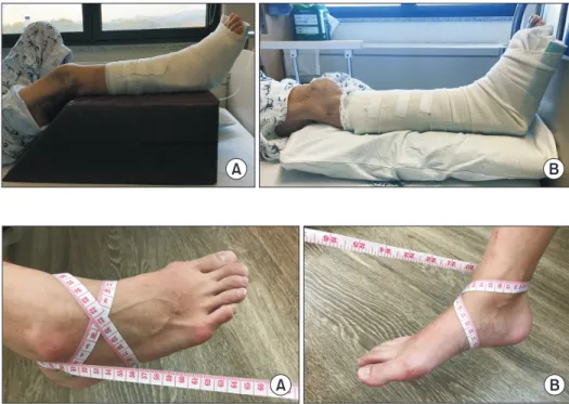 Figure 1. (A) Elevated leg with cushion eleva- eleva-tor (30 cm-height) and (B) pillow elevaeleva-tor (10  cm-height) on the bed