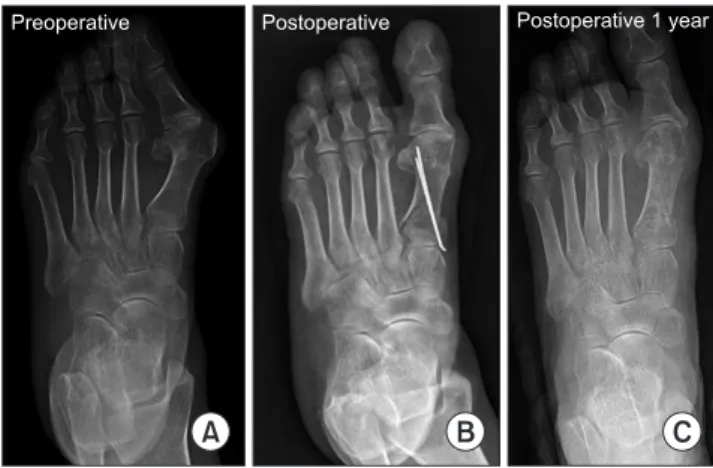 Table 1. Comparison of Radiographic Outcomes between Two Groups Radiographic outcome Group 1 Group 2 p-value*