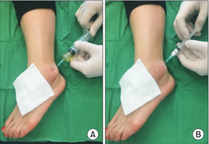 Figure 2. (A) Aspiration of left ankle lateral malleolar bursitis with  21-gauge needle of 20 mL synringe