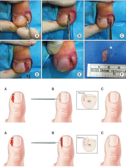 Figure 1. Simple partial nail extraction. (A)  Elevate nail edge with freer elevator. (B)  Cut adequate amount of nail with scissor  deep to proximal nail plate