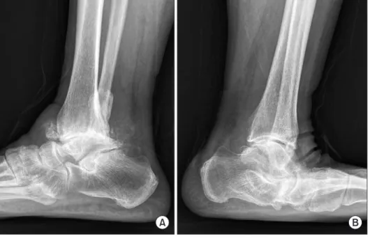 Figure 1. (A) Lateral radiograph show- show-ing the severe rheumatoid arthritis of the  right ankle
