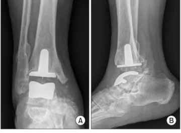 Figure 5. Anteroposterior (A) and lateral (B) radiographs at 3 years  postoperatively show a well-maintained total ankle arthroplasty  de-spite heterotopic ossification.