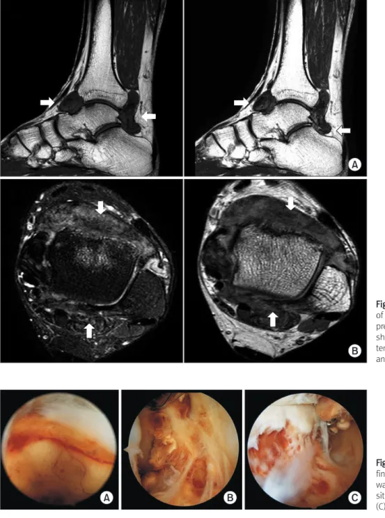 Figure 1. Magnetic resonance imaging  of left ankle. T1-, T2-weighted fat  sup-pressed sagittal (A) and axial (B) images  show large sized mass of low signal  in-tensity in anterior and posterior aspect of  ankle (arrows).