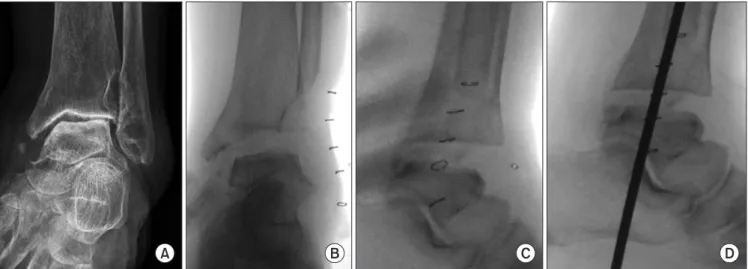 Figure 1. (A) The left ankle of a 78-year-old female with rheumatoid arthritis shows marked secondary arthritis