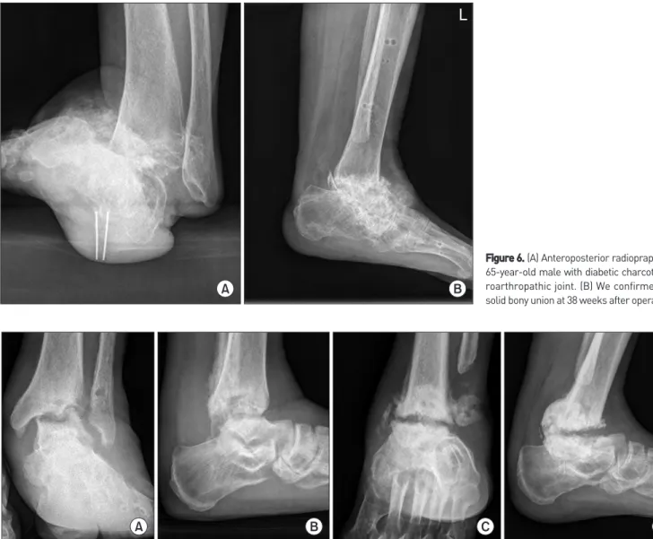 Figure 6. (A) Anteroposterior radiopraph of a  65-year-old male with diabetic charcot  neu-roarthropathic joint