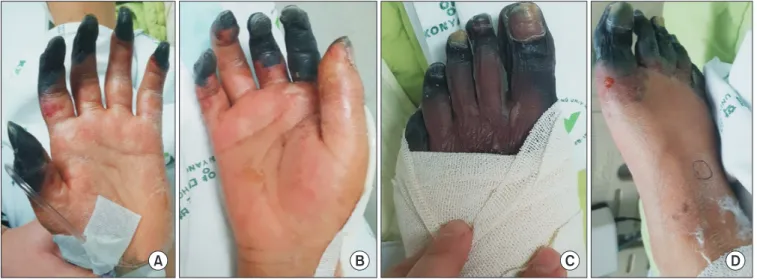 Figure 1. Initial gross photos of the patient are shown. Digital necrotic lesions of both hands (A, B) and both feet (C, D) are shown.