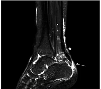 Figure 1. Clinical photo of initial injury treated using Krackow locking loop  technique