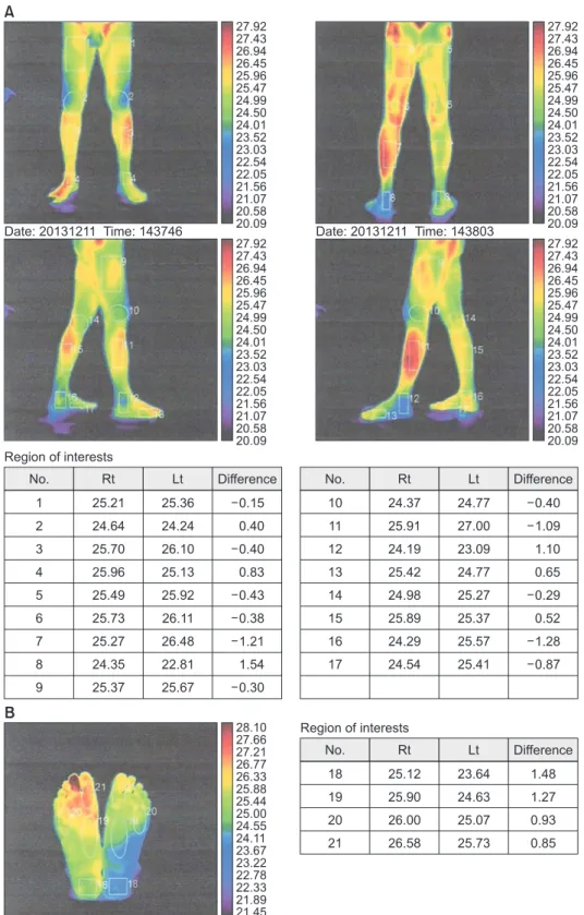 Figure 2. A 63-year-old male digital  infrared thermal imaging (DITI) before  medication