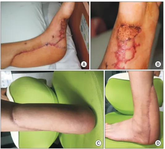 Figure 5. Gross photography (A) and plan- plan-tar area (B) of foot flap site of 1 month  after the surgery shows no complications