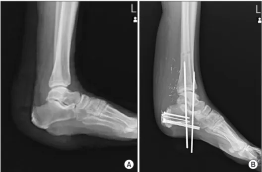 Figure 6. (A) Preoperative simple lateral  radiography shows soft tissue damage. 