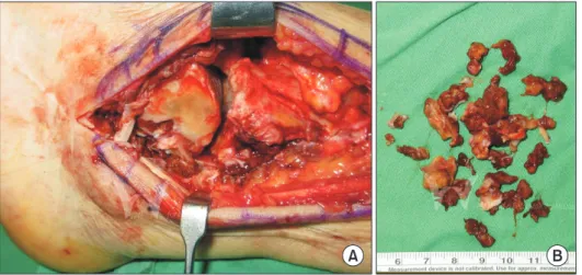 Figure 2. (A) Reddish synovial mass  around the ankle joint. (B) Near complete  synovectomy was performed through  lateral approach