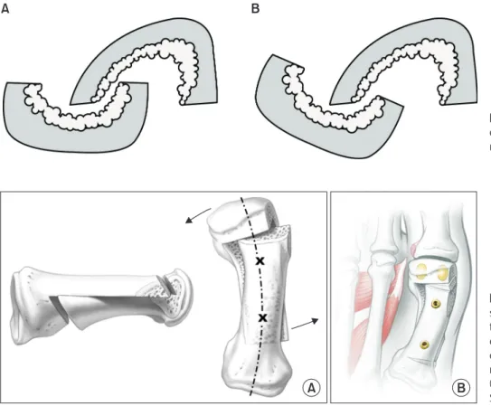 Figure 6. Complications of scarf oste- oste-otomy. (A) Troughing. (B) Troughing with  malrotation.