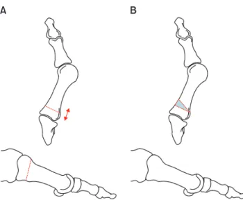 Figure 10. (A) Proximal chevron (base proximal) osteotomy. (B) Proxi- Proxi-mal chevron (base distal) osteotomy.