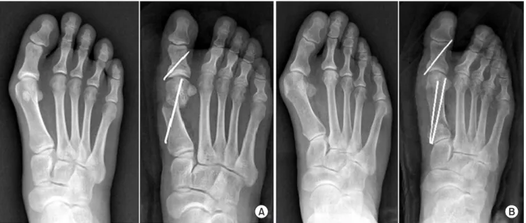 Figure 1. (A) In cases of intermetatarsal angle (IMA) less than 15。 , distal chevron osteotomy was performed and one 1.6 mm-diameter Kirschner wire  (K-wire) was fixed