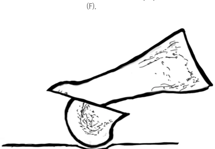 Figure 2. When the angle of the Weil osteotomy is more vertical than  the weightbearing surface of the foot, plantar displacement of the  metatarsal head during the shortening of the metatarsal will coincide.