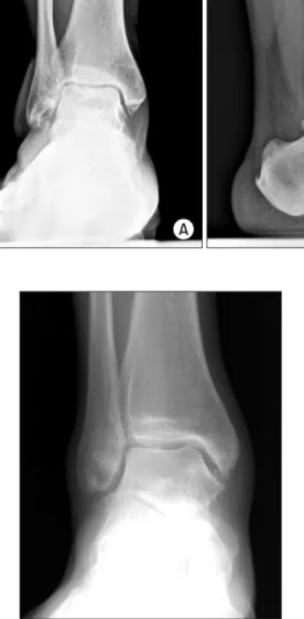 Figure 2. Simple radiographs of early osteoarthritis. Figure 3. Computed tomography (CT) of early ankle osteoarthritis
