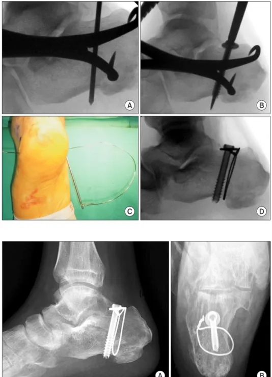Figure 2. Surgical technique. (A) After  paratendinous longitudinal incision,  open reduction was done using reduction  clamp and guide pin was inserted