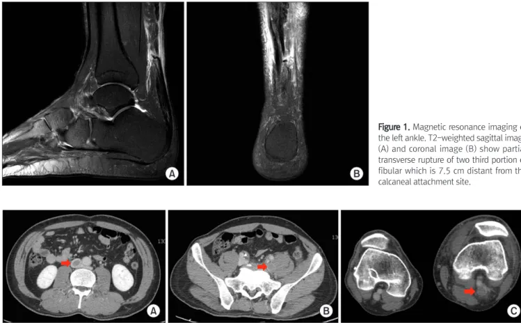Figure 2. The intraoperative photo of left ruptured Achilles tendon. (A)  Medial portion of the Achilles tendon was ruptured at mid calf