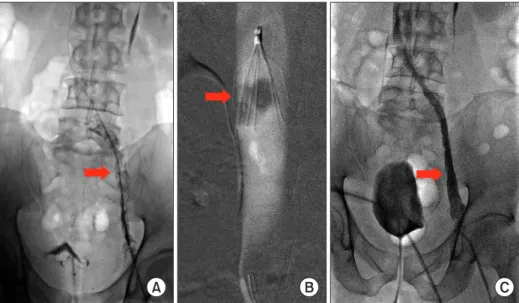 Figure 4. Angiointervention. (A) Venous  flow is blocked at inferior vena cava (IVC)  (arrow)