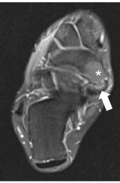 Figure 1. Bone marrow edema between navicular proper (asterisk) and  accessory navicular (arrow) was found in proton-density weighted  turbo spin-echo axial magnetic resonance imaging.