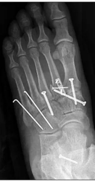 Figure 3. First, second, third tarsometatarsal joints were fixed with 