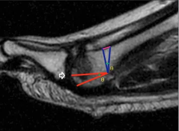 Figure 1. Triangle was drawn at metatarsal neck to measure the  amount of osteotomy using the tangent trigonometric ratio