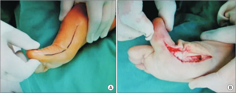 Figure 2. To be parallel to the plantar plane, the longitudinal osteotomy  line was rotated about coronal 20 o ∼30 o  and completed from medial (A)  to lateral cortex (B).