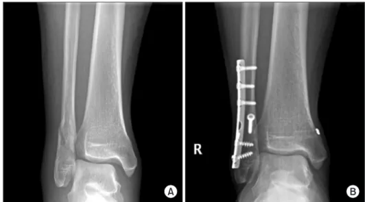 Figure 1. (A) Preoperative nonweightbear- nonweightbear-ing anteroposterior radiograph of a right  ankle demonstrates supination-external  rotation type ankle fracture