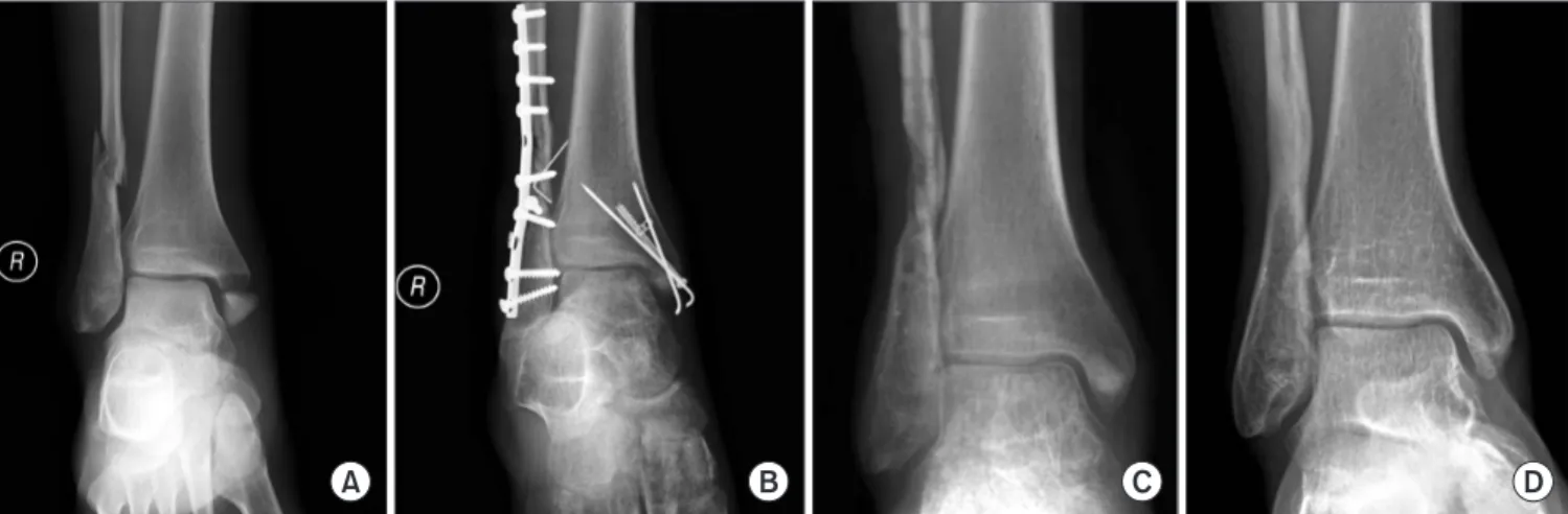 Figure 3. (A) Preoperative anteroposterior radiograph of a right ankle demonstrates pronation-external rotation type ankle fracture