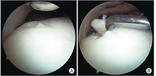 Figure 1. Redomicrofracture was per- per-formed for the treatment of osteochondral  lesion of talus (B) in which arthroscopic  microfracture has failed (A).