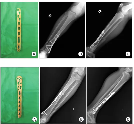 Figure 3. (A) This photograph demon- demon-strate locking compression plate distal  medial tibia (LCP-DMT; Synthes,  Solo-thurn, Switzerland)