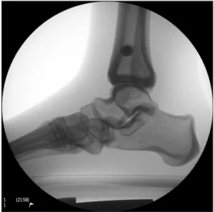 Figure 2. Both markers on phantom foot should overlap for the radia- radia-tion projecradia-tion to be parallel to the horizontal reference axis.