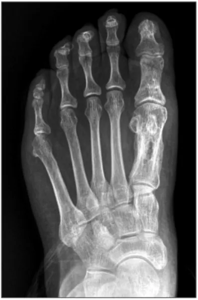 Figure 7. Radiograph at postoperative 12 months shows improved  alignment of the hallux and union of Akin osteotomy.