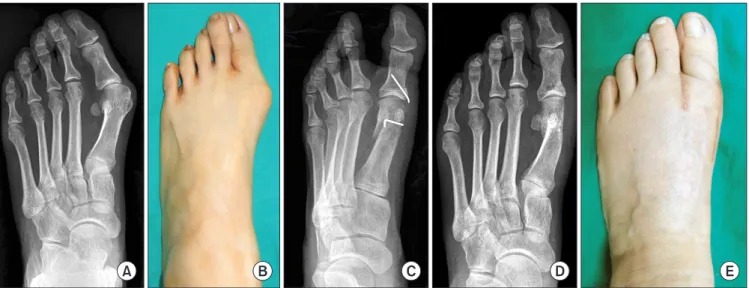 Table 1. Radiographic Data after Distal Chevron Osteotomy with and  without Akin Osteotomy