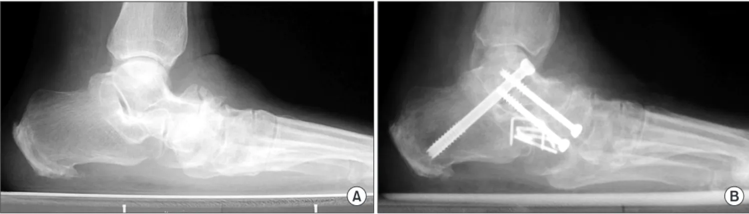 Figure 4. (A) Stage 3 acquired adult flatfoot deformity was seen at preoperative standing lateral radiograph of 47-year-old male patient