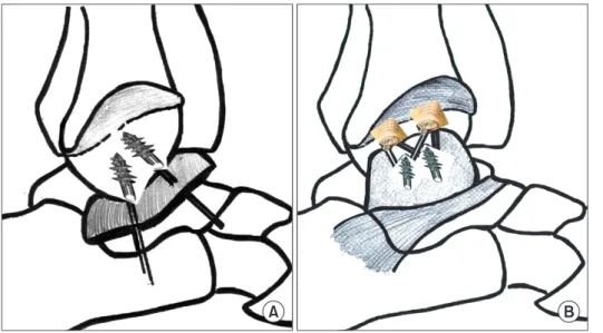 Figure 1. (A) Schematic drawing of the  suture bridge technique describes the  attachment of lateral ankle ligaments  with two suture anchors