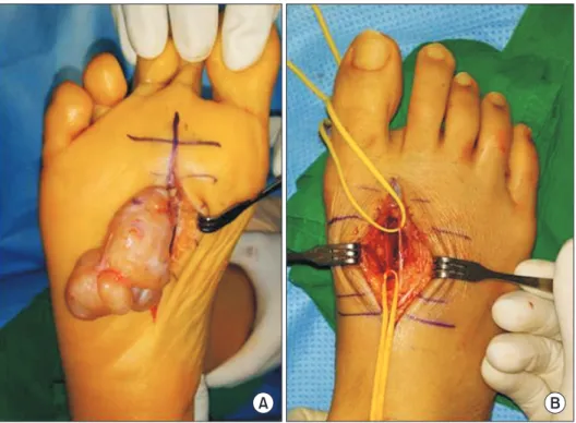 Figure 3. (A) A excised mass was removed  through plantar incision. (B) Clinical  pho-tograph after mass excision shows both  a deep peroneal nerve and a common  proper digital nerve derived from medial  plantar nerve.